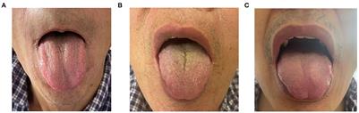 Relationship between thick or greasy tongue-coating microbiota and tongue diagnosis in patients with primary liver cancer